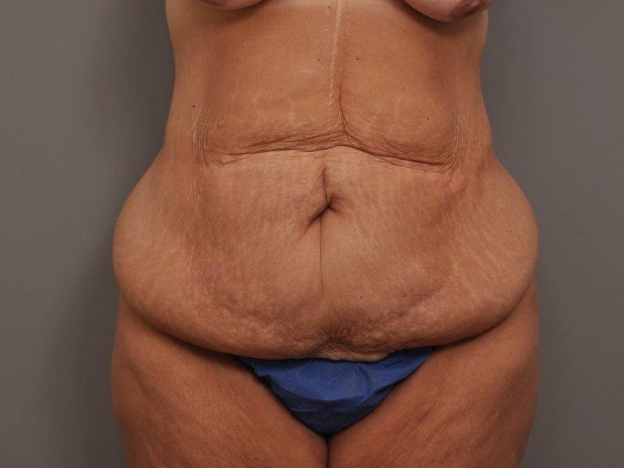 Abdominoplasty front view Before