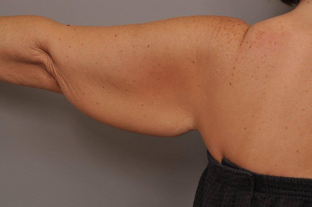 Brachioplasty back view Before