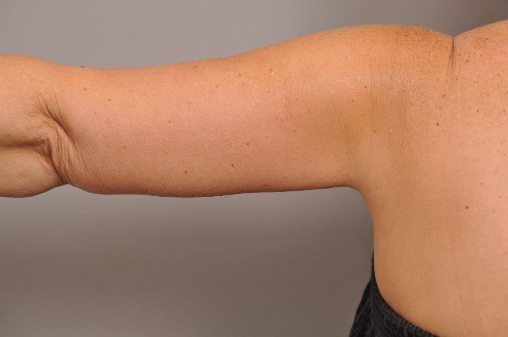 Brachioplasty back view After