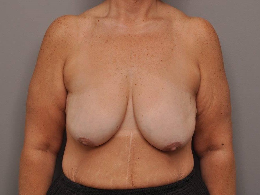 Post Bariatric Mastopexy Before
