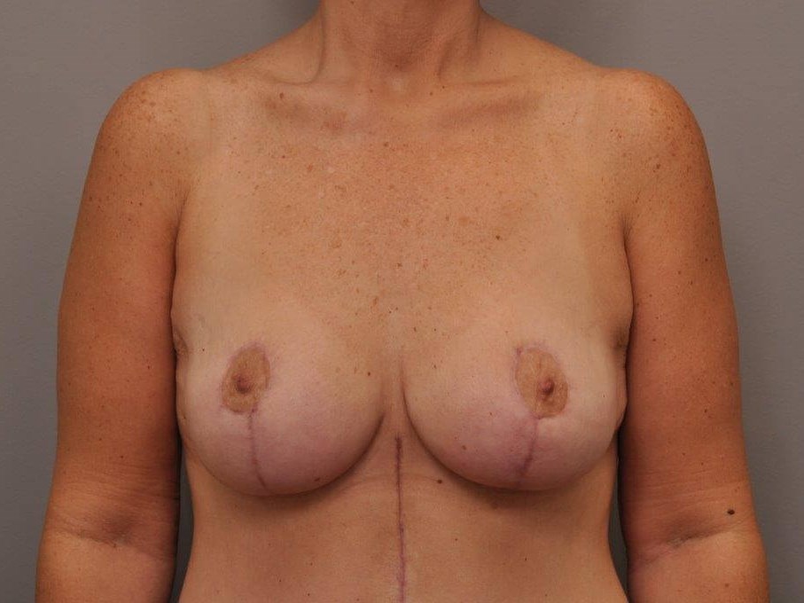Post Bariatric Mastopexy After