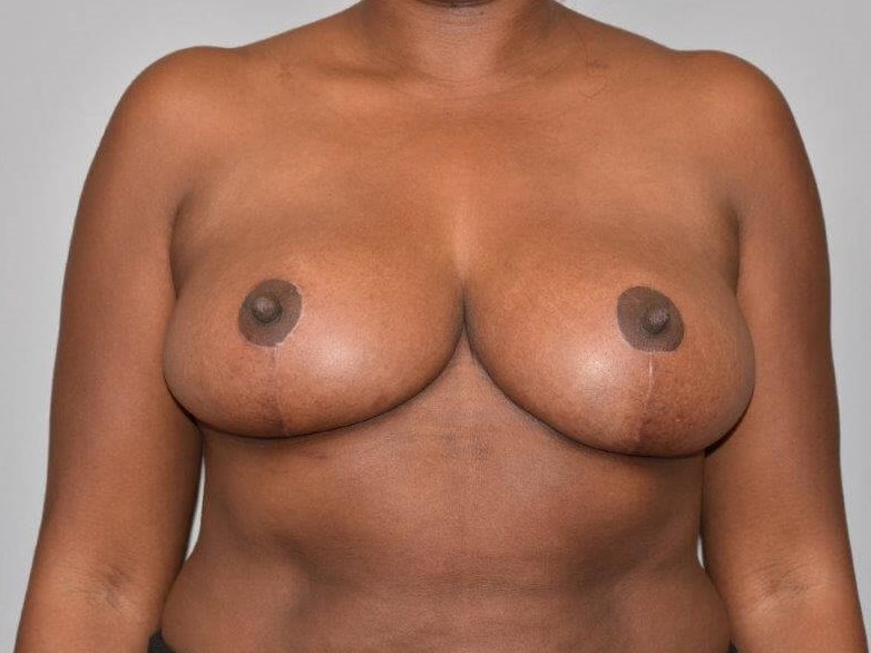 Breast Reduction front view After