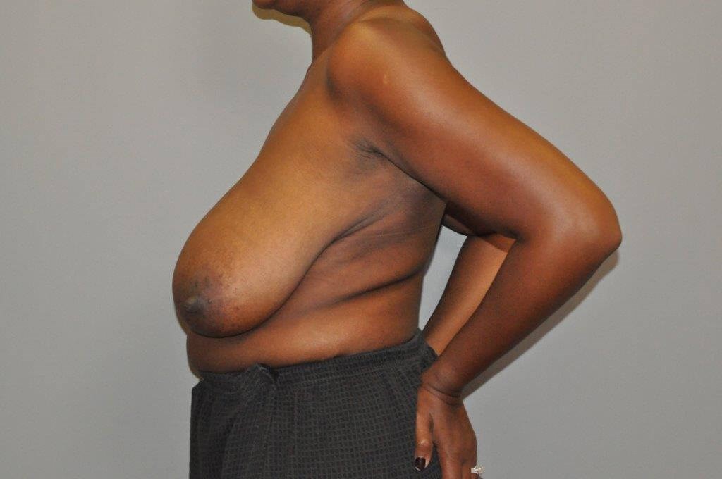 Breast Reduction side view Before
