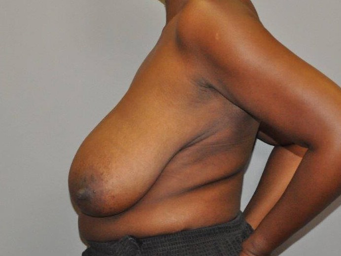 Breast Reduction side view Before