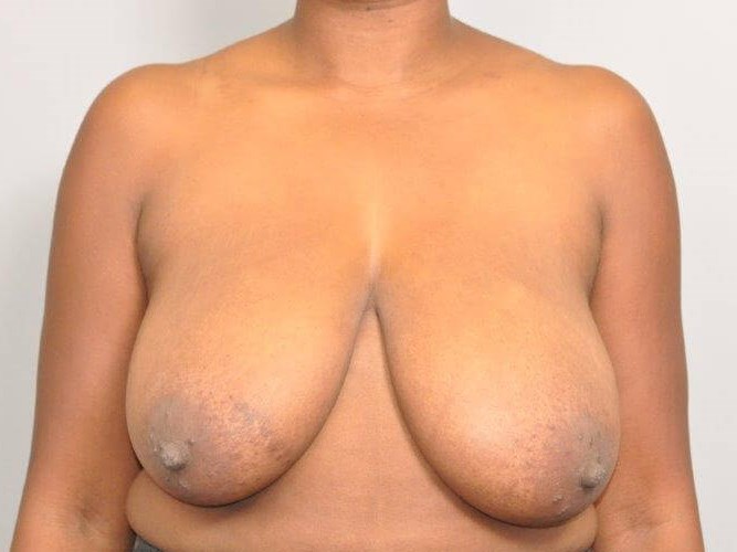 Breast Reduction front view Before