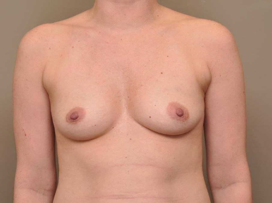 Breast Augmentation front view Before
