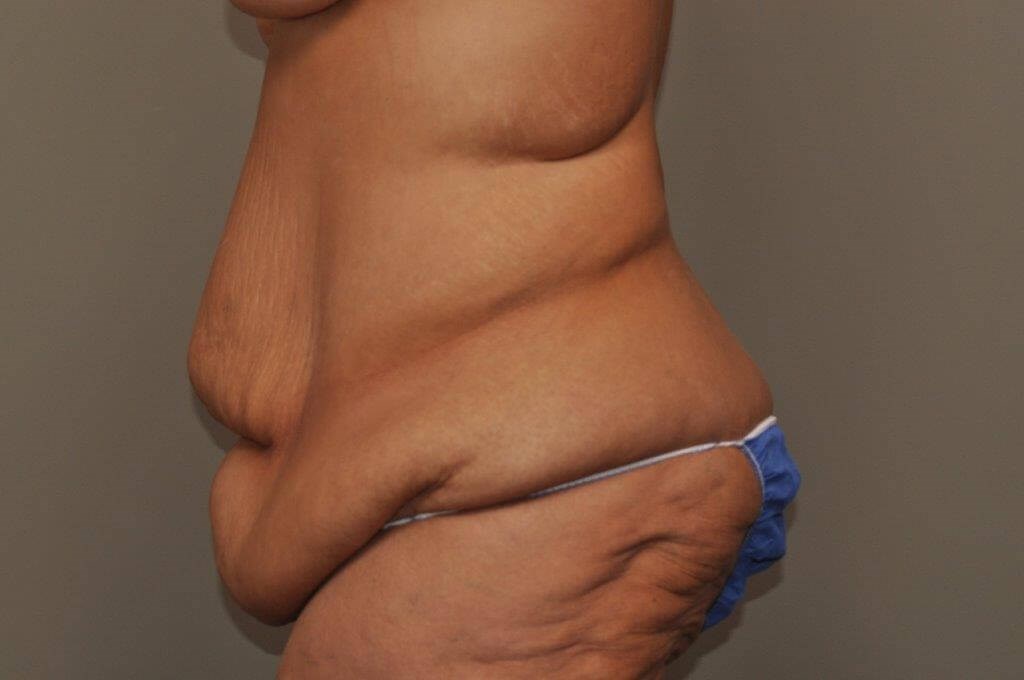 Post Bariatric Bodylift side Before