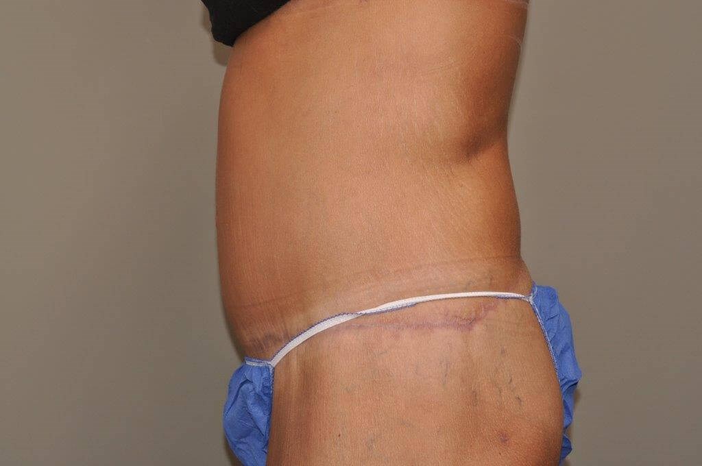 Post Bariatric Bodylift side After
