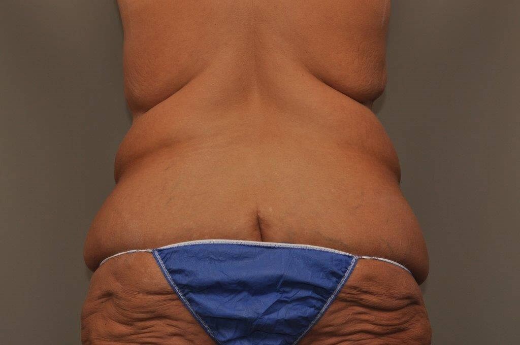 Post Bariatric Bodylift back Before