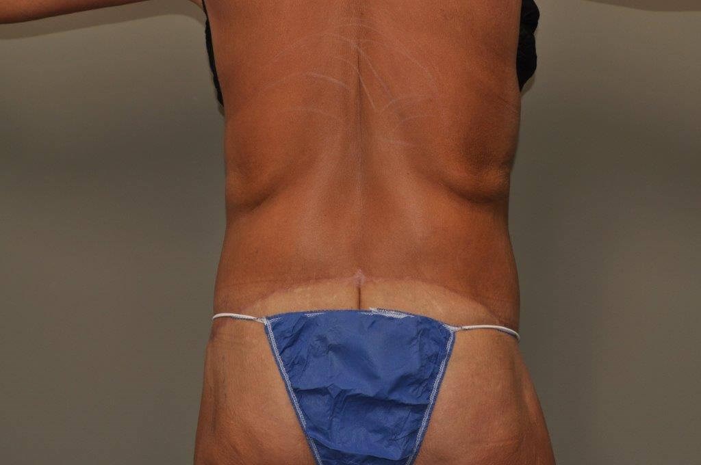 Post Bariatric Bodylift back After