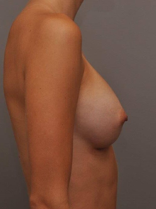 Breast Augmentation Side View After