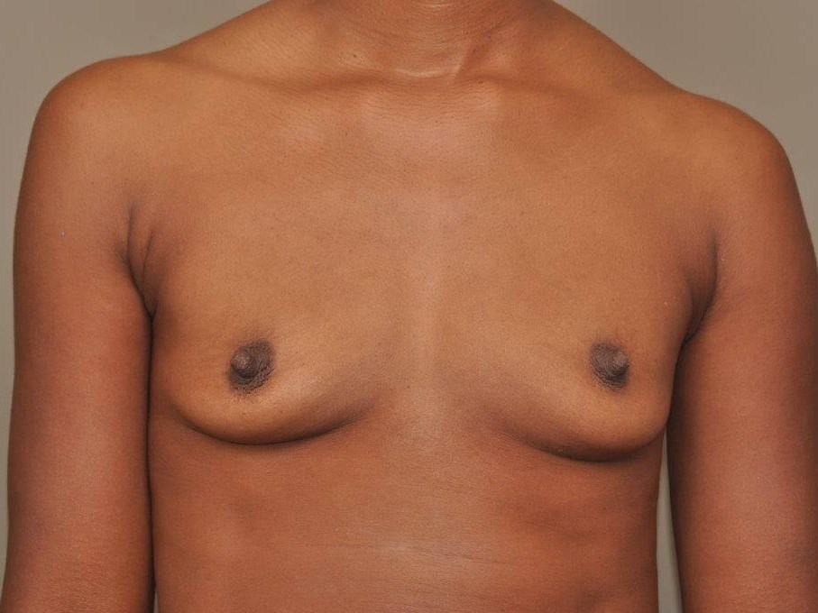 Breast Augmentation Front View Before
