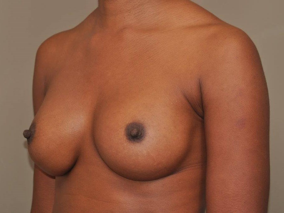 Breast Augmentation Angle View After