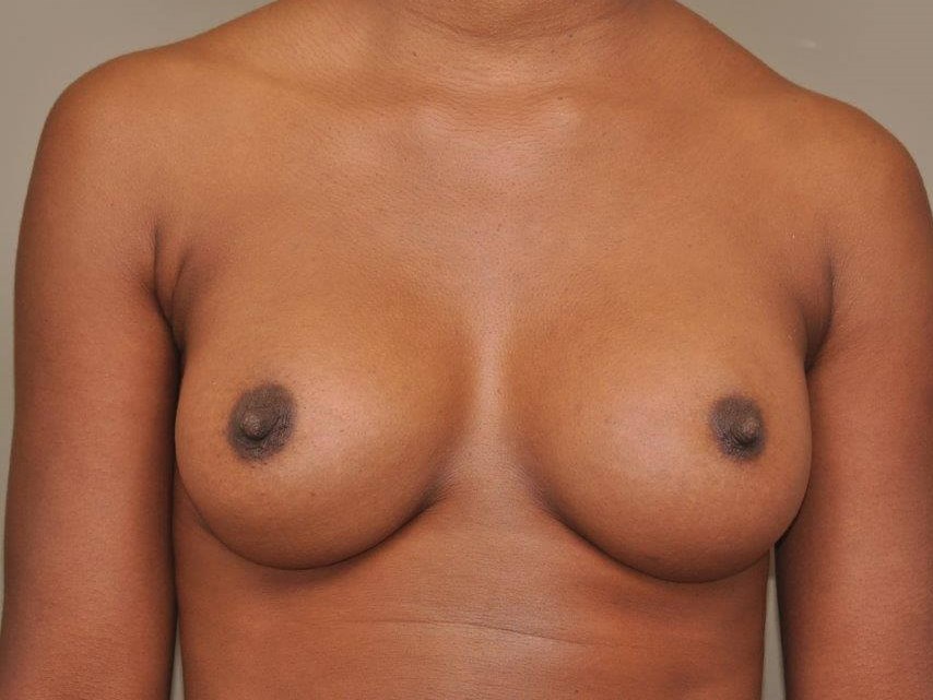Breast Augmentation Front View After