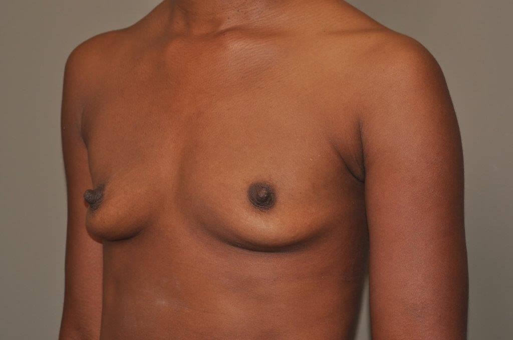 Breast Augmentation Angle View Before