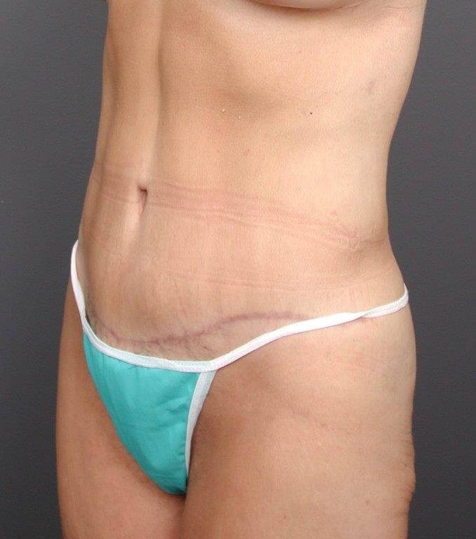 Abdominoplasty Front View After