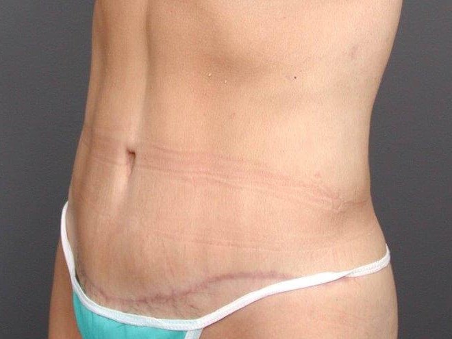Abdominoplasty Front View After