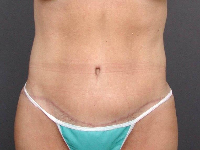 Abdominoplasty Front View After