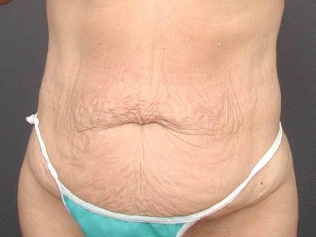 Abdominoplasty Front View Before
