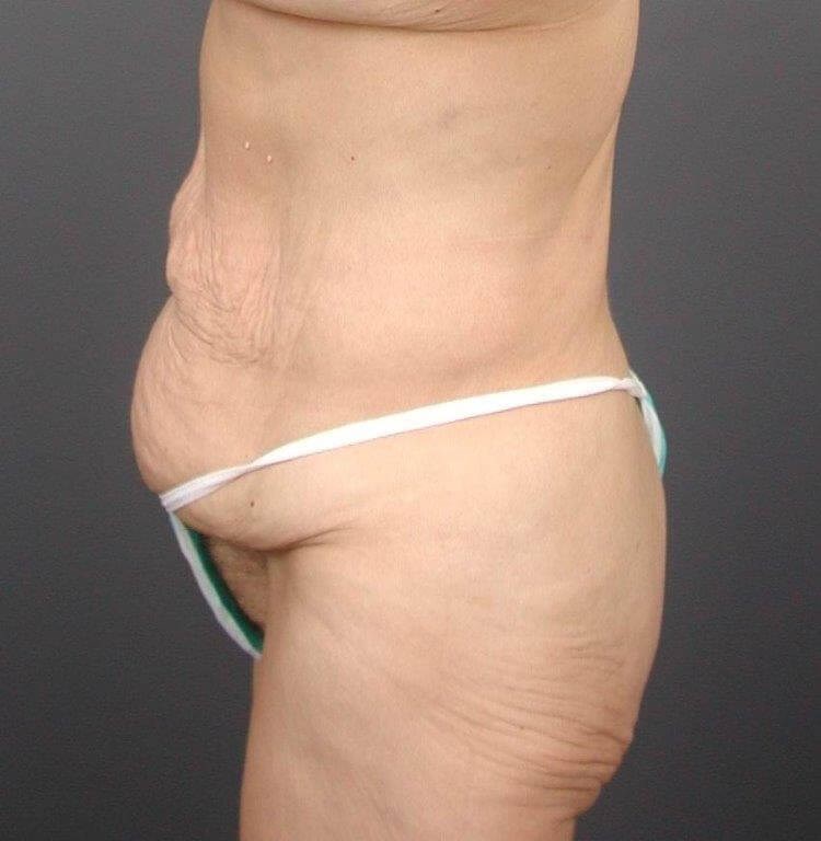 Abdominoplasty Front View Before