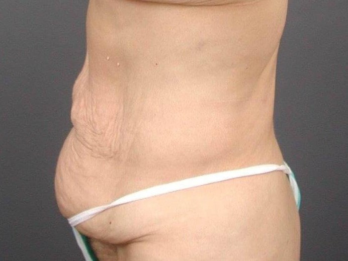 Abdominoplasty Front View Before