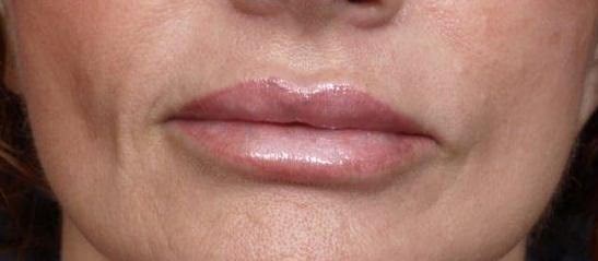 Lip Enhancement Front View After