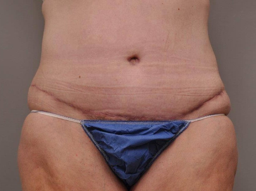 Post Bariatric Tummy Tuck After