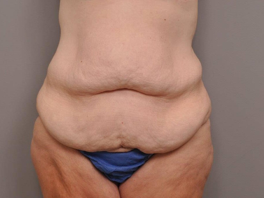 Post Bariatric Tummy Tuck Before