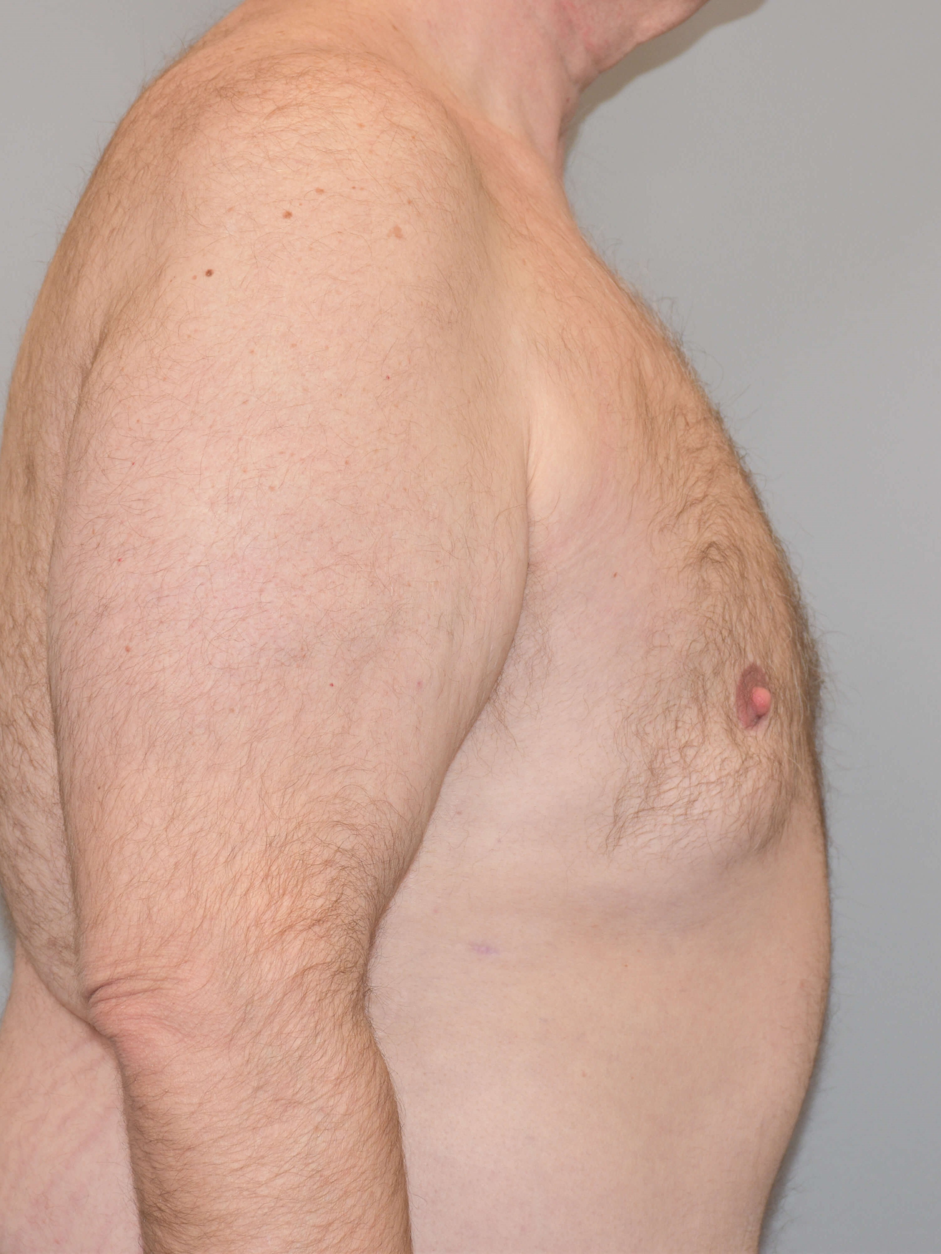 Gynecomastia Front View After