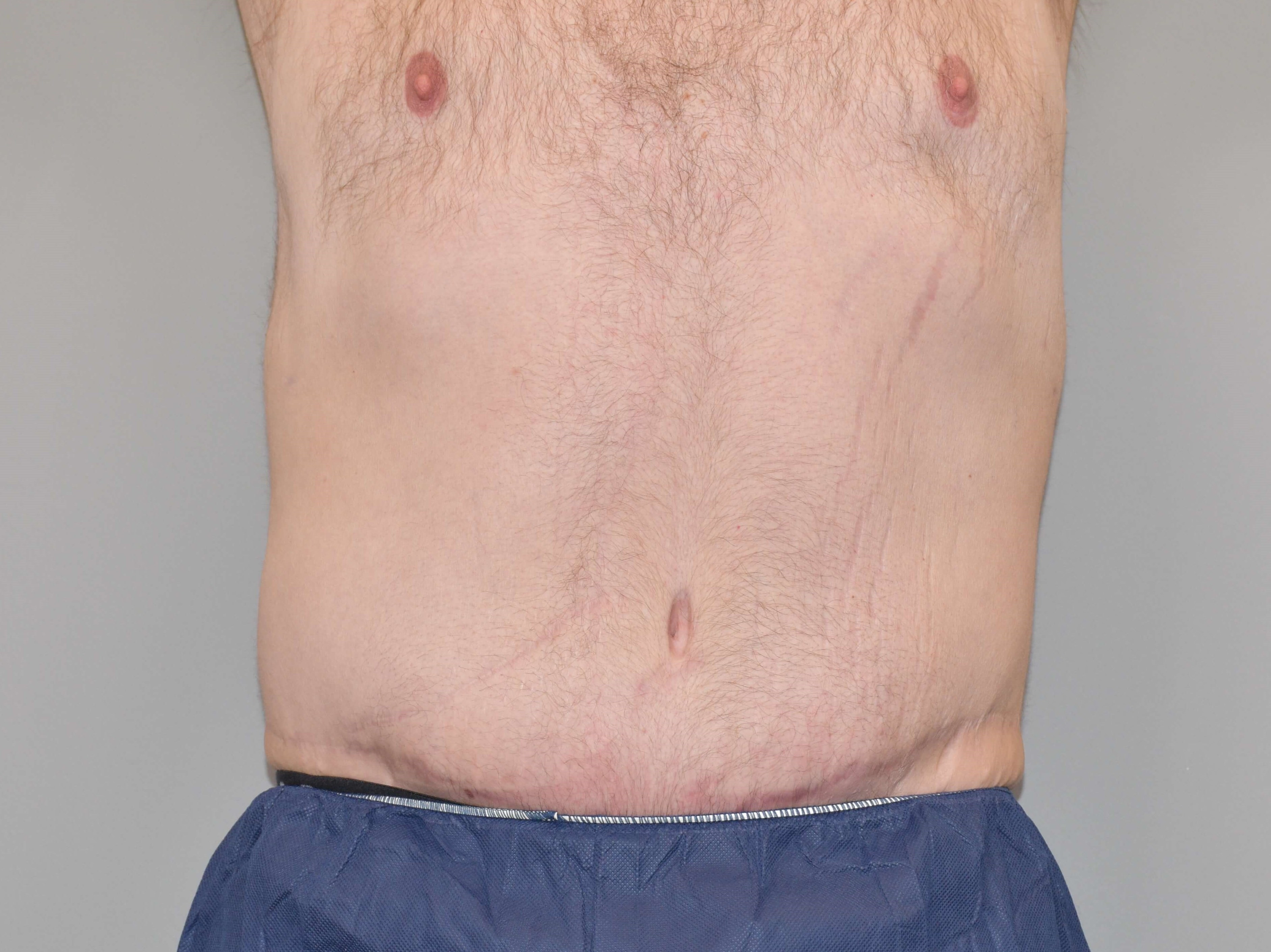 Post Bariatric Tummy Tuck After
