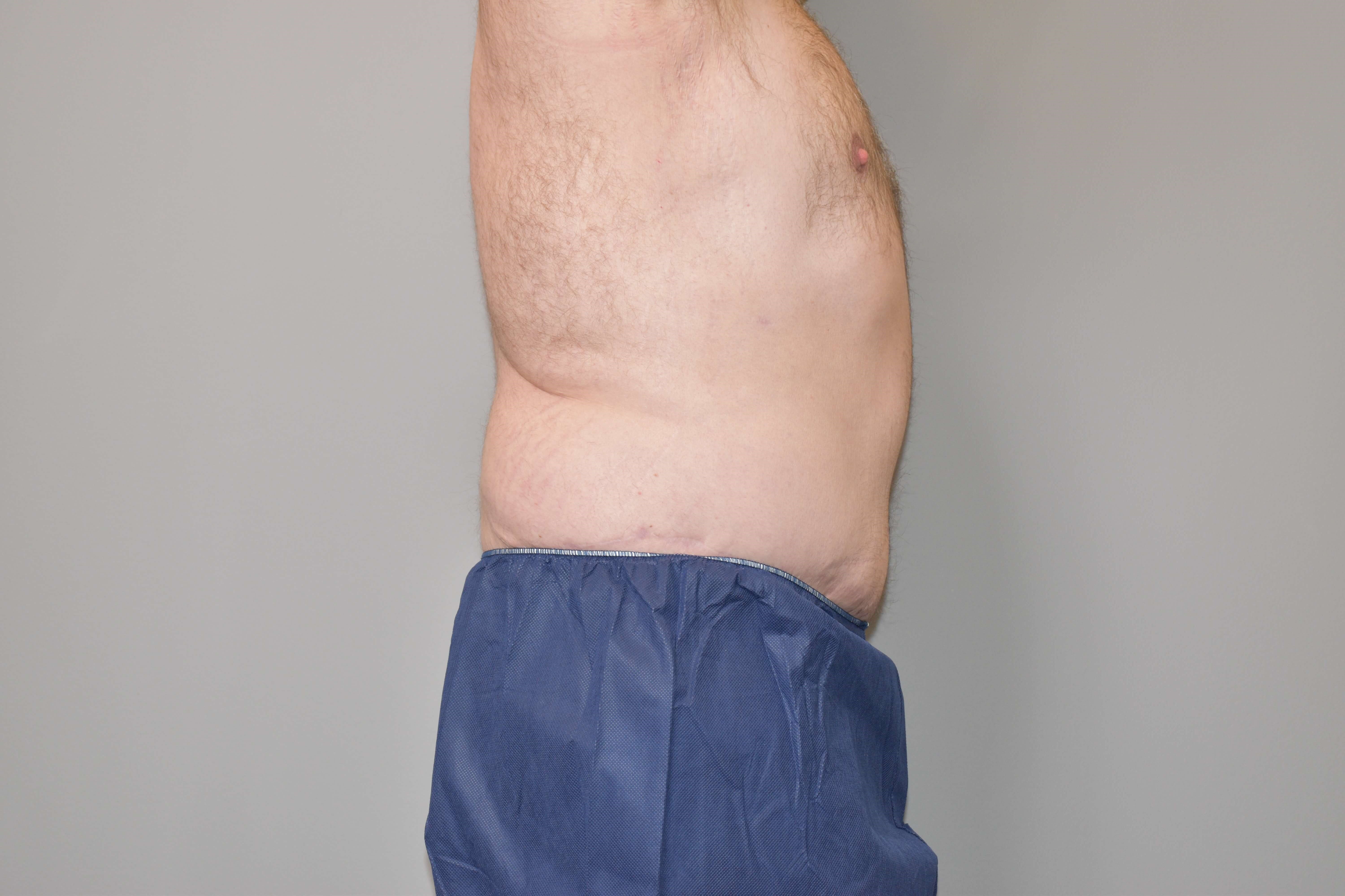 Post Bariatric Tummy Tuck After