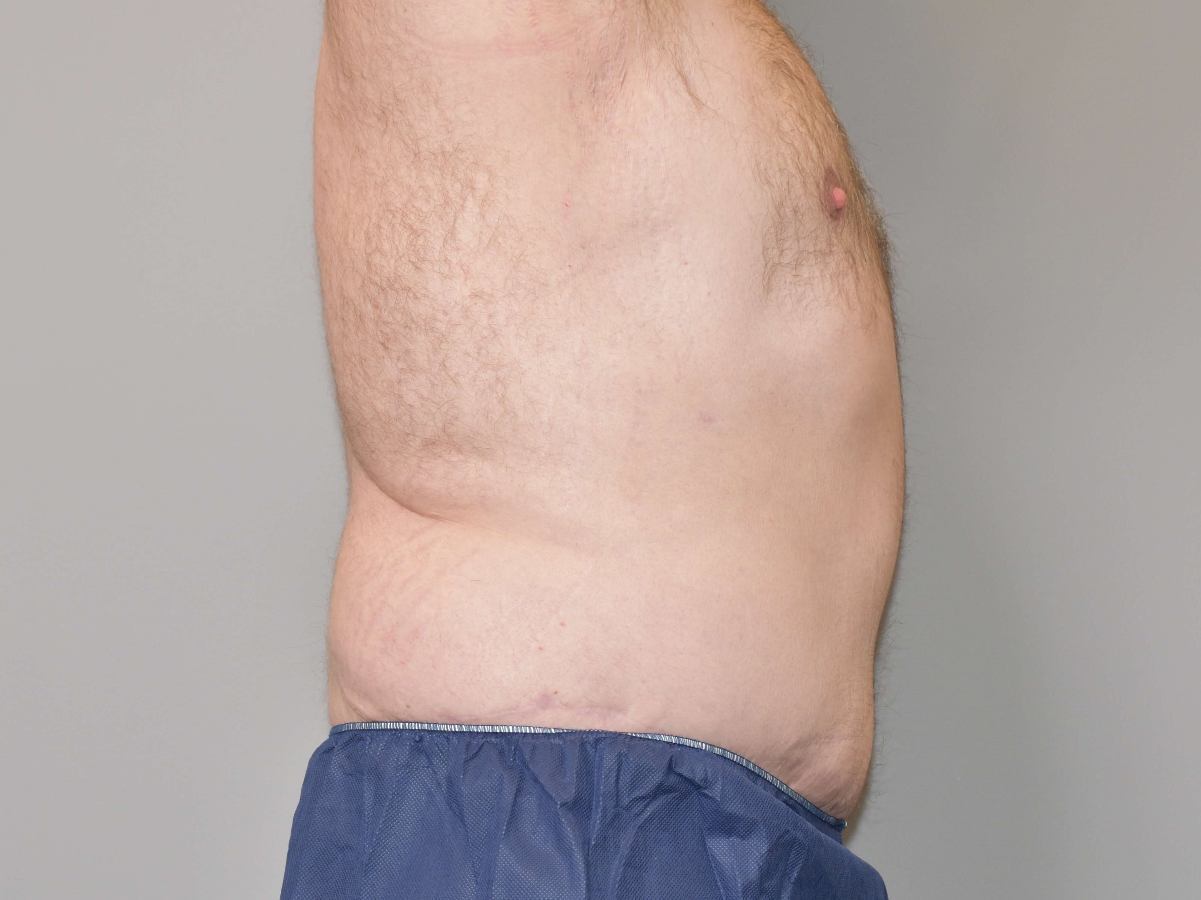 Post Bariatric Tummy Tuck After