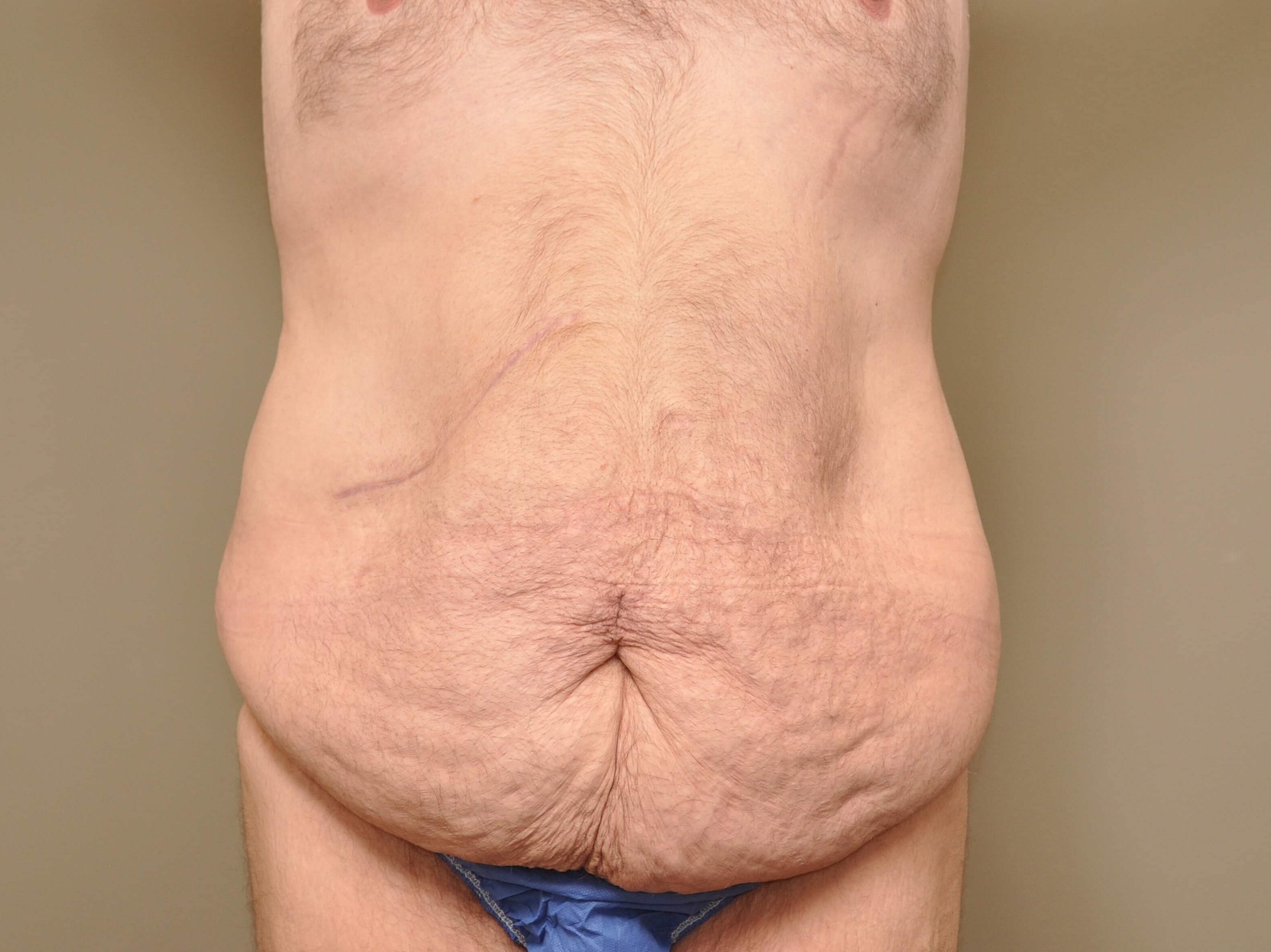 Post Bariatric Tummy Tuck Before