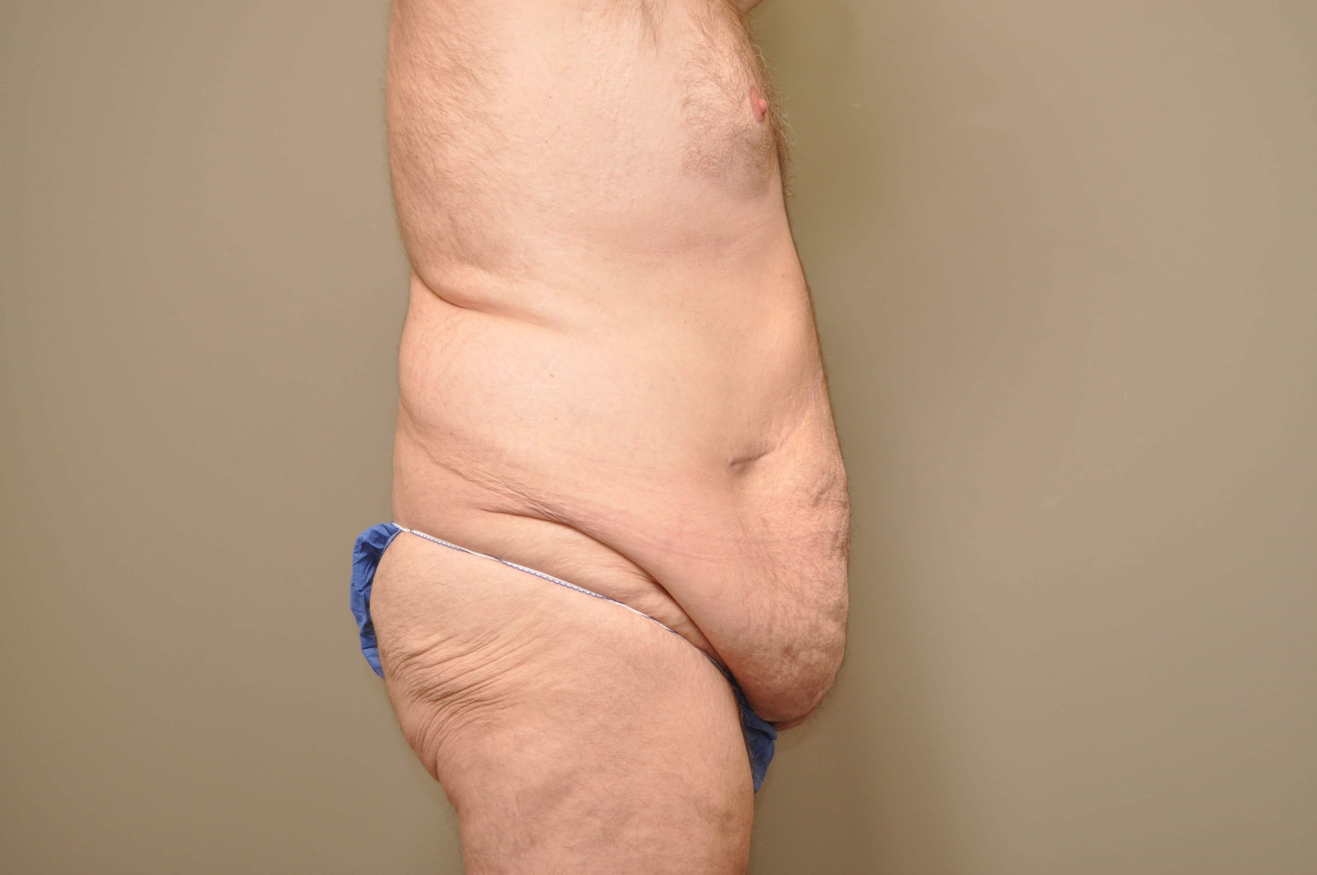 Post Bariatric Tummy Tuck Before