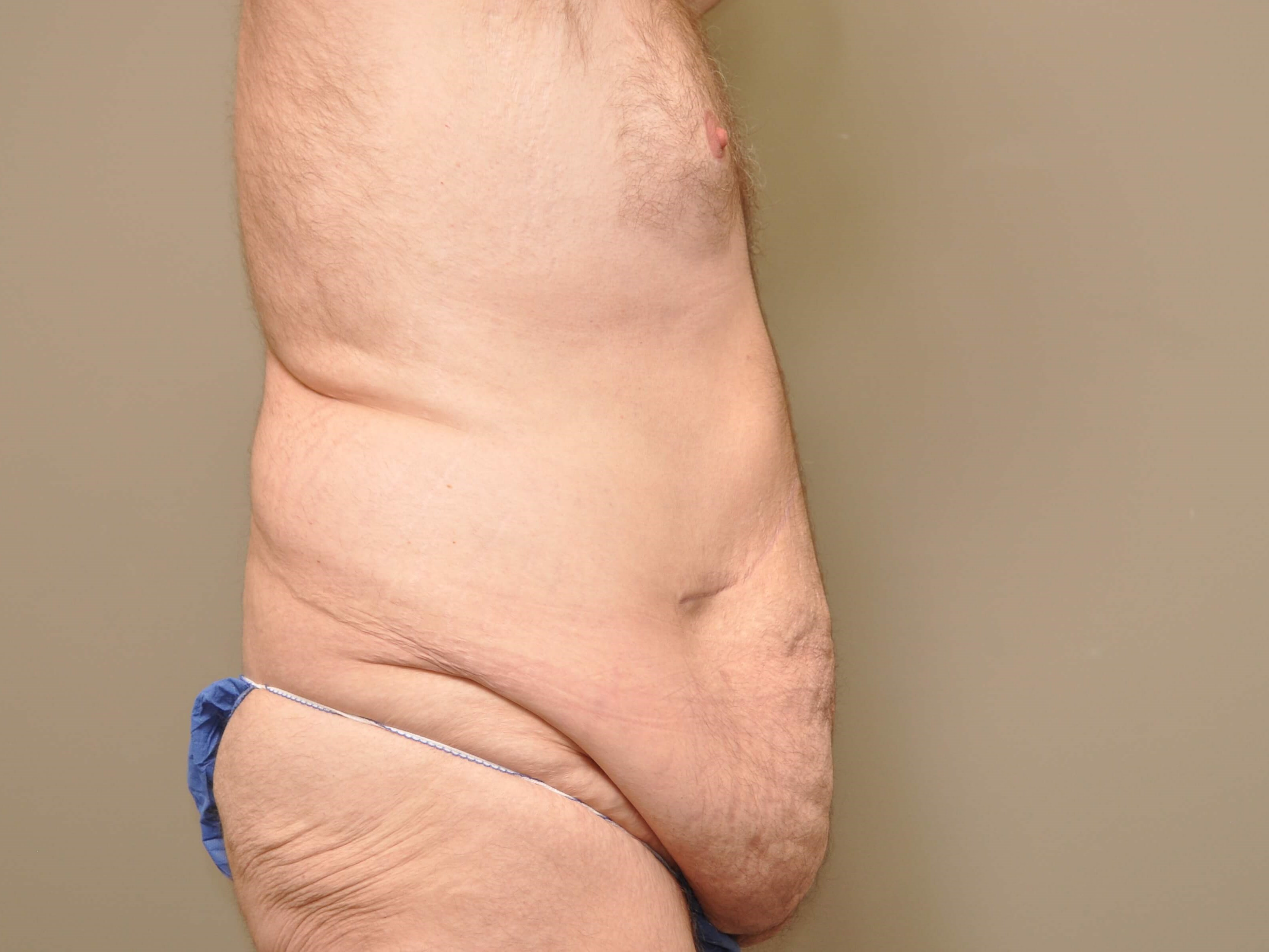 Post Bariatric Tummy Tuck Before