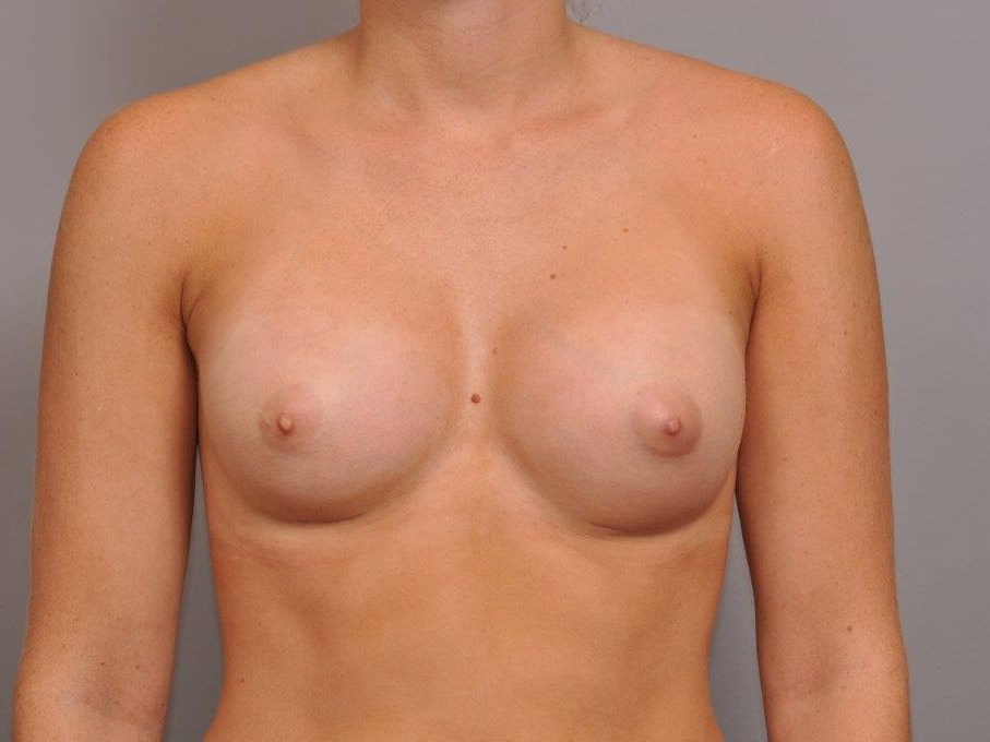 Breast Augmentation Front View After