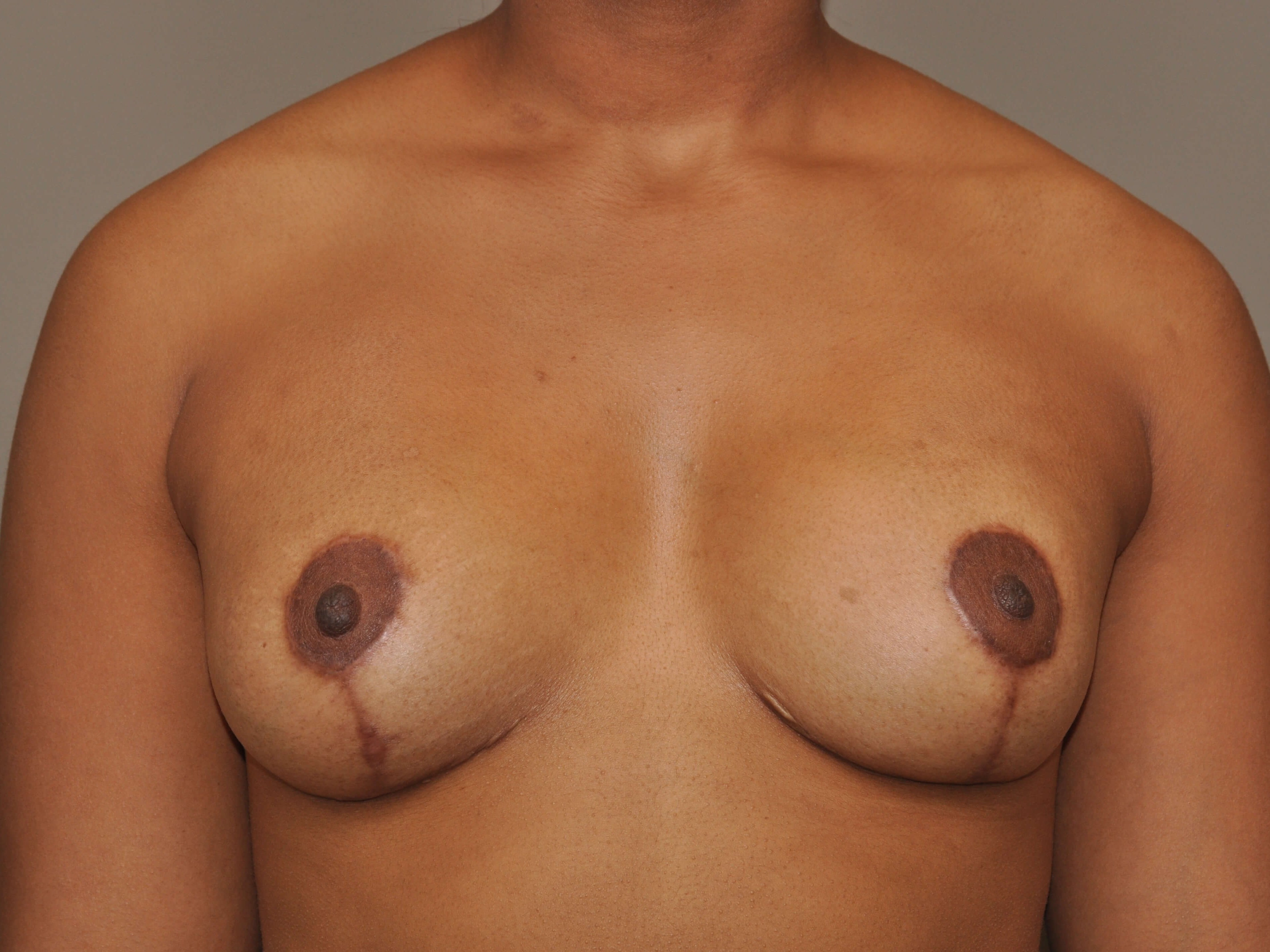 Mastopexy/Augmentation Front After
