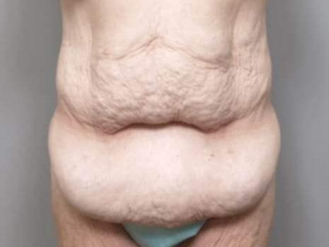 Massive Weight Loss Front View Before