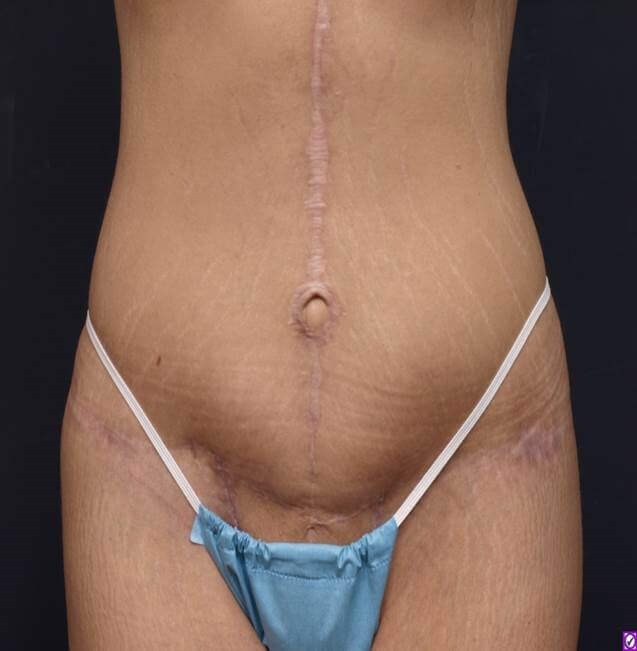 Massive Weight Loss Front View After