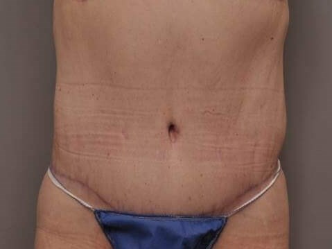 Massive Weight Loss Front View After