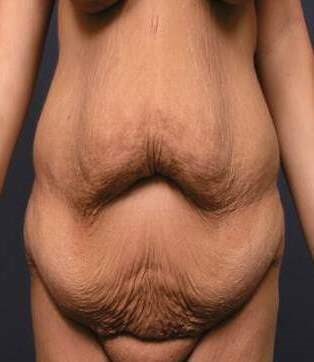 Massive Weight Loss Front View Before