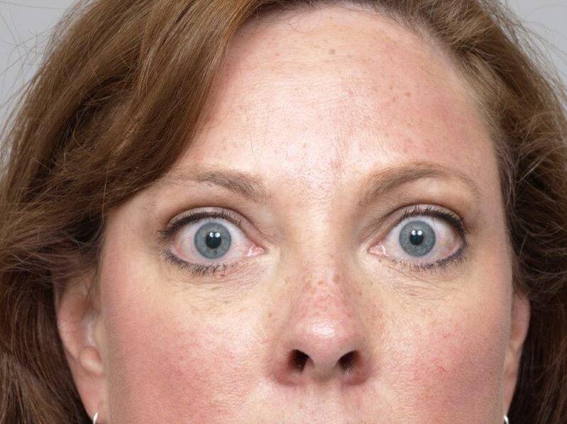 Lower Bleph Front View After