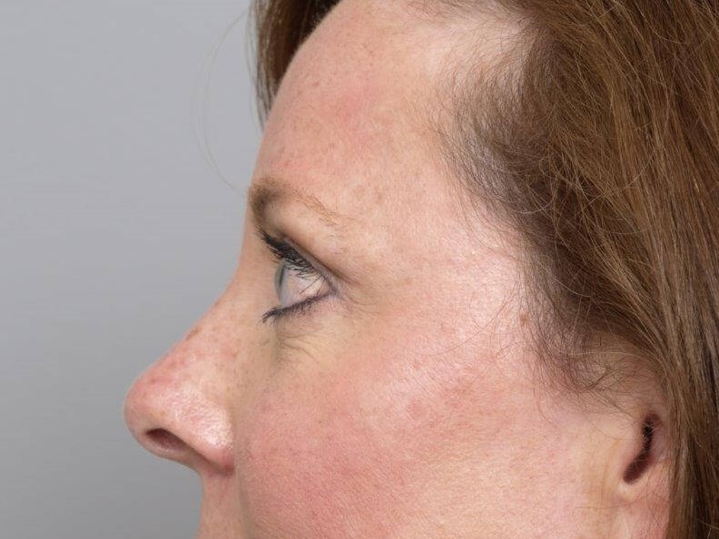 Lower Bleph Left Side View After