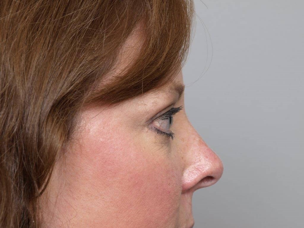 Lower Bleph Right Side View After