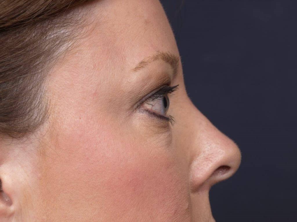 Lower Bleph Right Side View Before