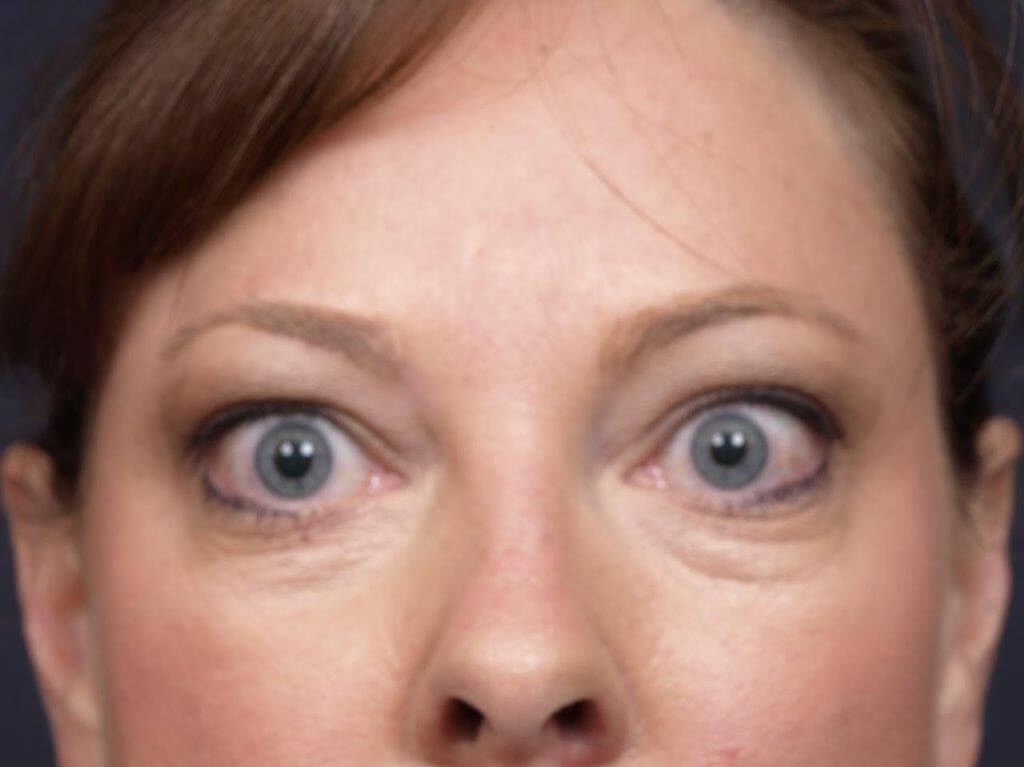 Lower Bleph Front View Before