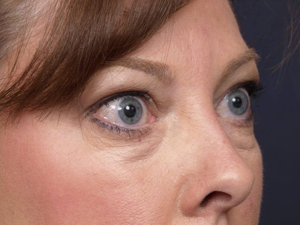 Lower Bleph Right Angled View Before