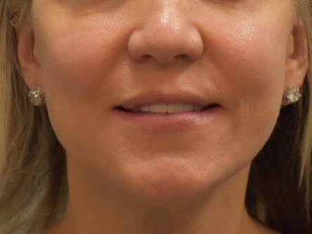 Lip Enhancement Front View Before