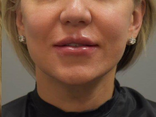 Lip Enhancement Front View After