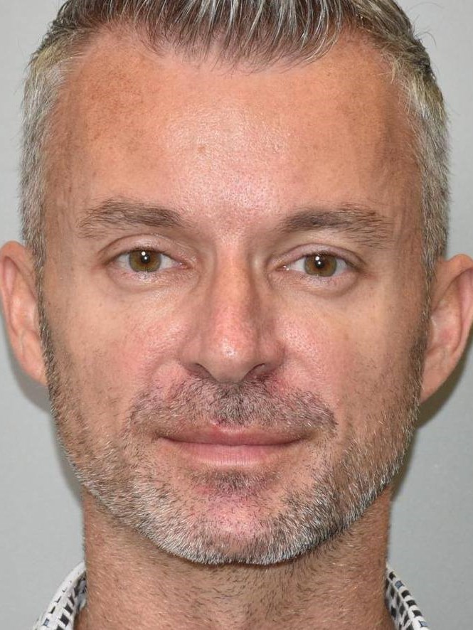 Sculptra Front View Before